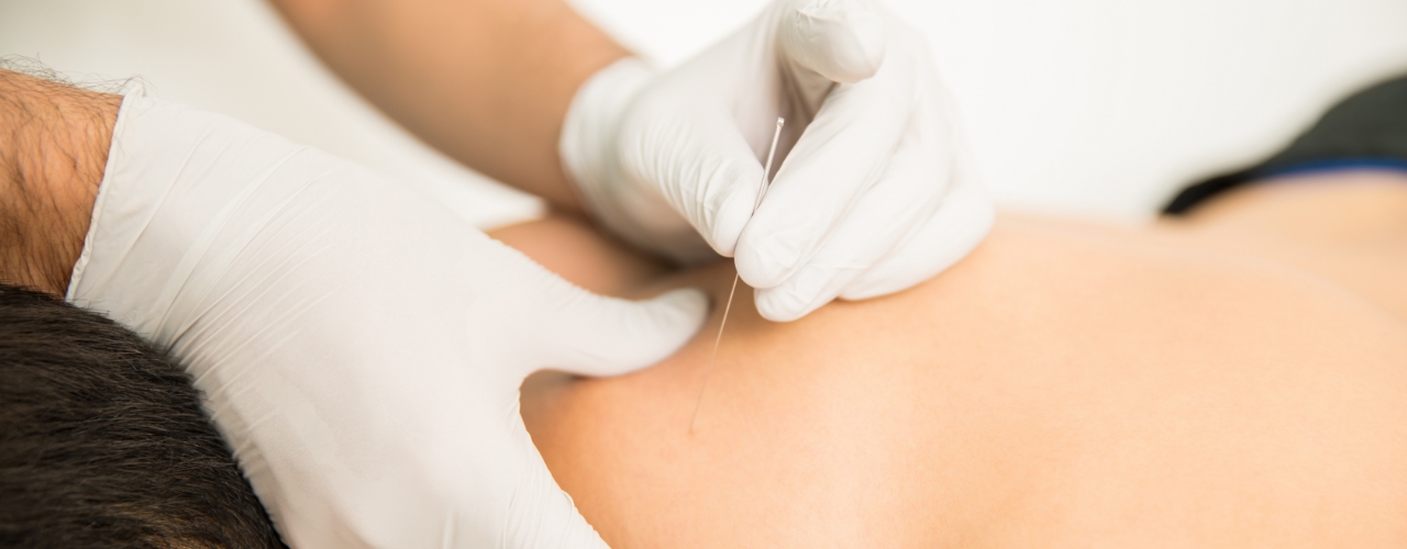 dry-needling-Revive-Physical-Therapy-Burgaw-Wallace-NC